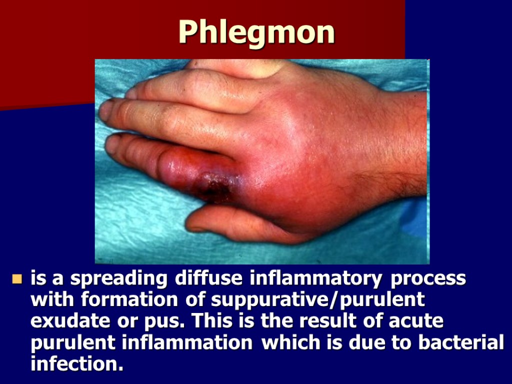 Phlegmon is a spreading diffuse inflammatory process with formation of suppurative/purulent exudate or pus.